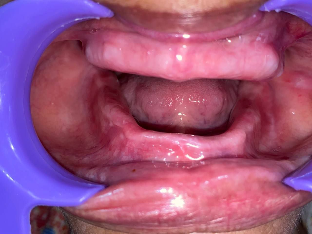Full Mouth Implant 2 — intraoperative